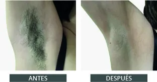 Antes y después de la depilación láser con Elysion Pro (1)