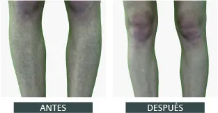 Antes y después de la depilación láser con Elysion Pro (2)