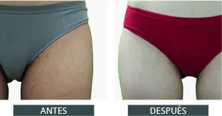 Antes y después de la depilación láser con Elysion Pro (3)