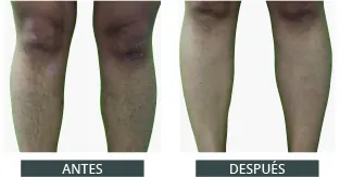 Antes y después de la depilación láser con Elysion Pro (4)