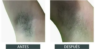 Antes y después de la depilación láser con Elysion Pro (5)