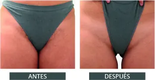 Antes y después de la depilación láser con Elysion Pro (6)