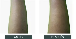 Antes y después de la depilación láser con Elysion Pro (7)