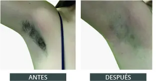 Antes y después de la depilación láser con Elysion Pro (8)