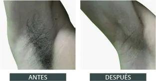 Antes y después de la depilación láser con Elysion Pro (9)