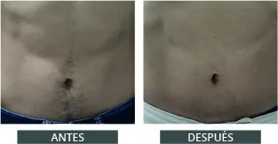 Antes y después de la depilación láser con Elysion Pro (10)